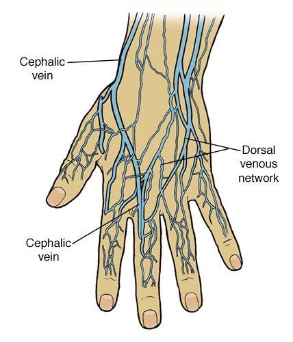 Varicose Veins of the Hands - Treatment at the Vein Treatment Center  Buffalo Niagara
