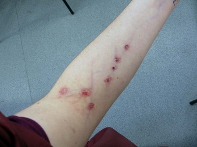 abscess_firstHeroin users arm