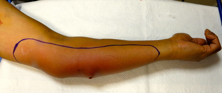 Cutaneous Complications of Intravenous Drug Abuse