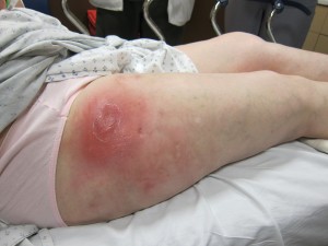 A fairly typical large abscess on a heroin user who seemed to have skin popped heroin.